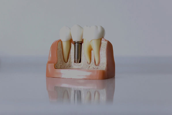 Root Canal_edited_edited_edited.jpg