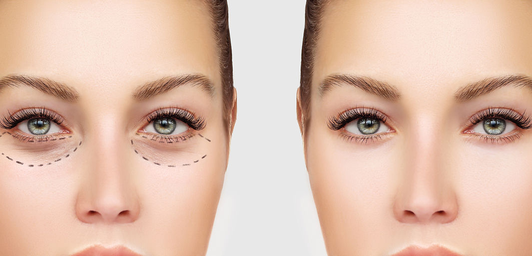 Before and After Botox