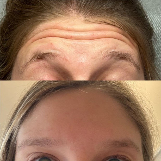 Botox Forehead