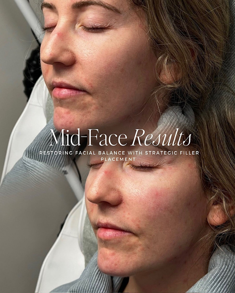 Mid Face Treatment