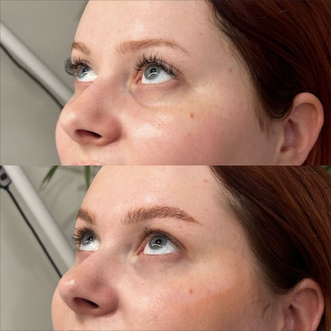 Under Eye Treatment