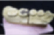 歯科技工詰め物4