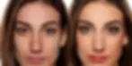 Acne Peel