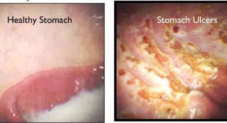 Gastric Ulcers in Performance Horses: A Man-Made Epidemic