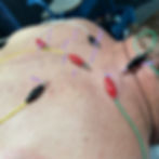 Dry Needling