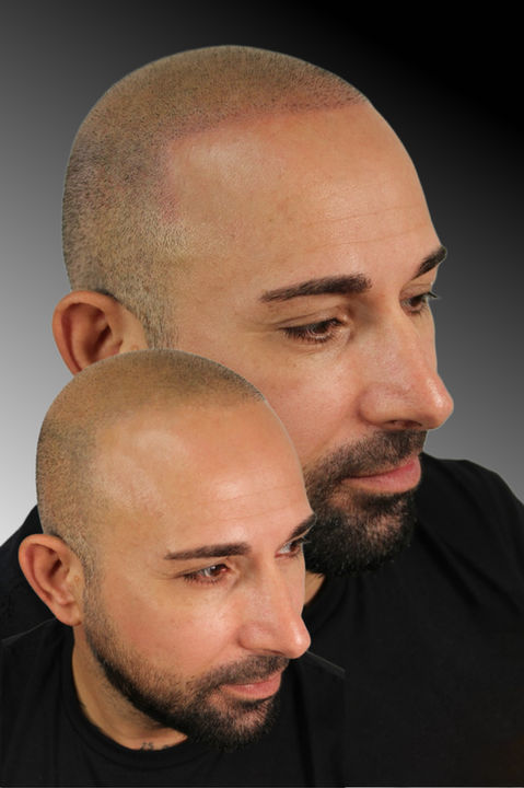 SMP - Scalp Micropigmentation vorher - nachher Foto 