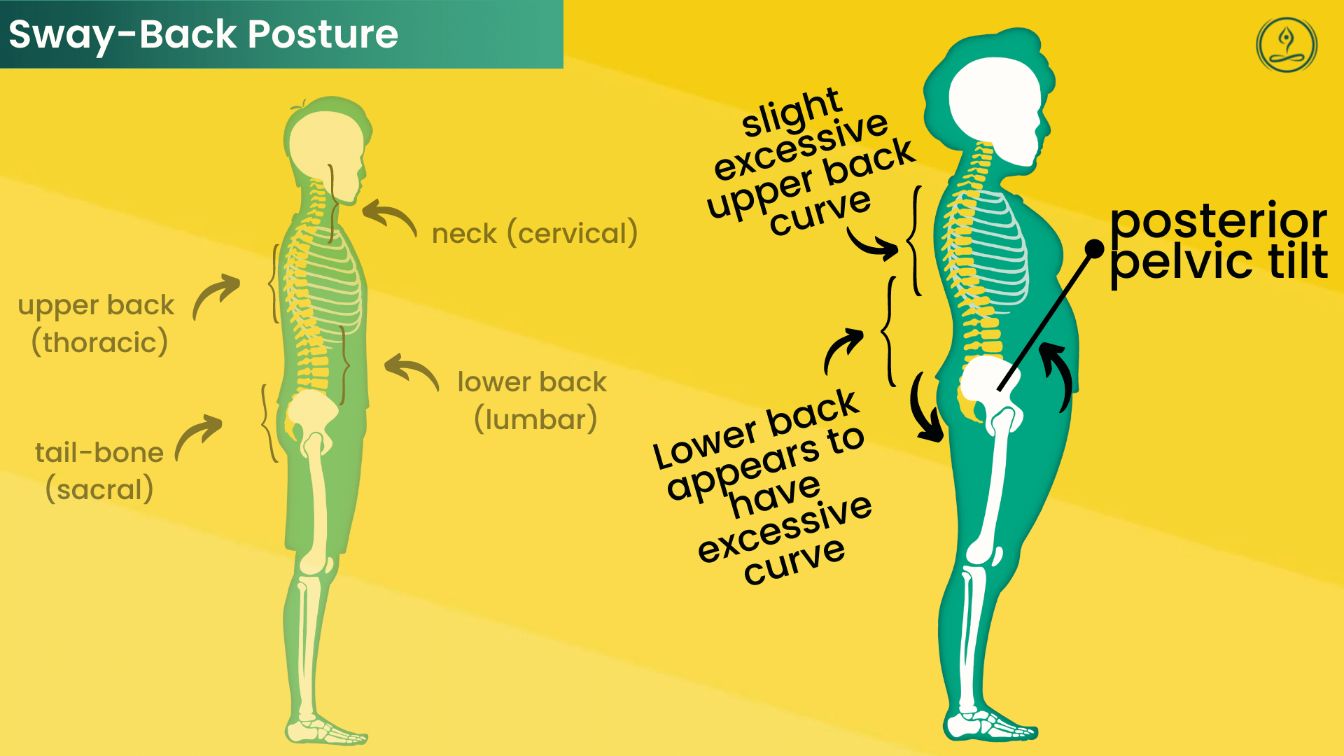 sway back posture