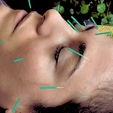 Facial Acupuncture