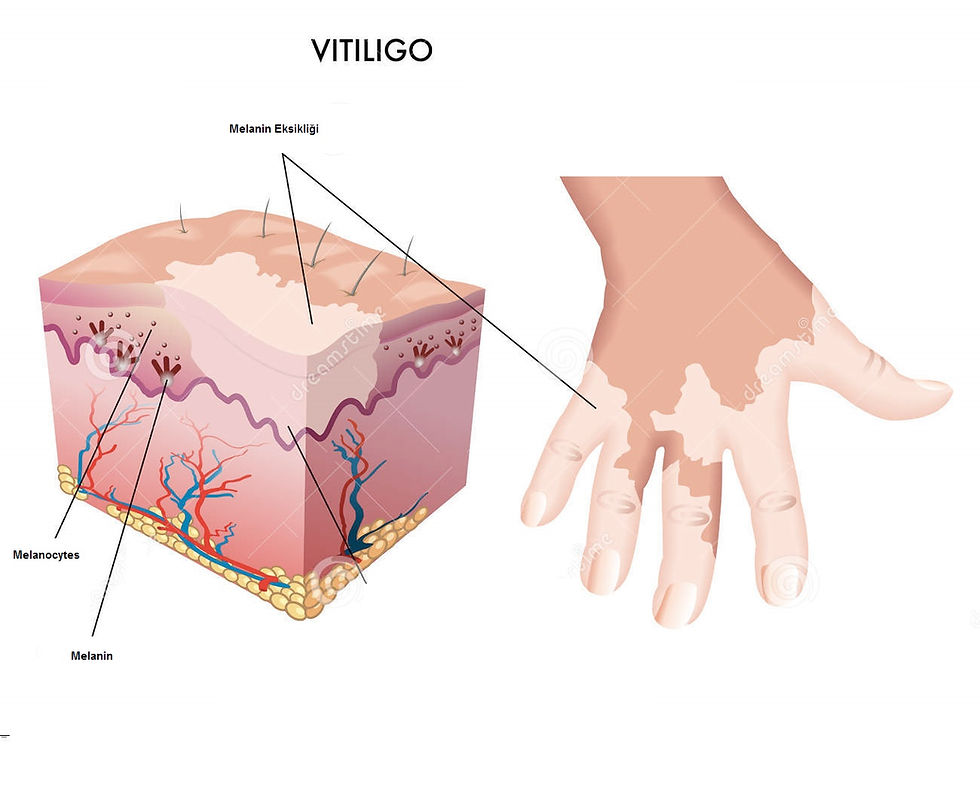 LR Aloe Vera Vitiligo