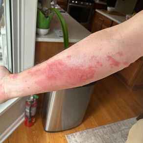 Poison Ivy Vaccine Anyone?