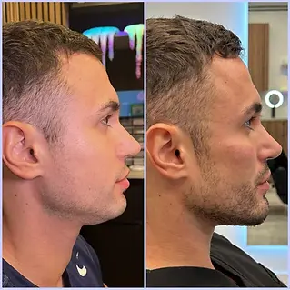 Best Jawline Filler performed by Dr. Randy Lindgren in Miami, FL