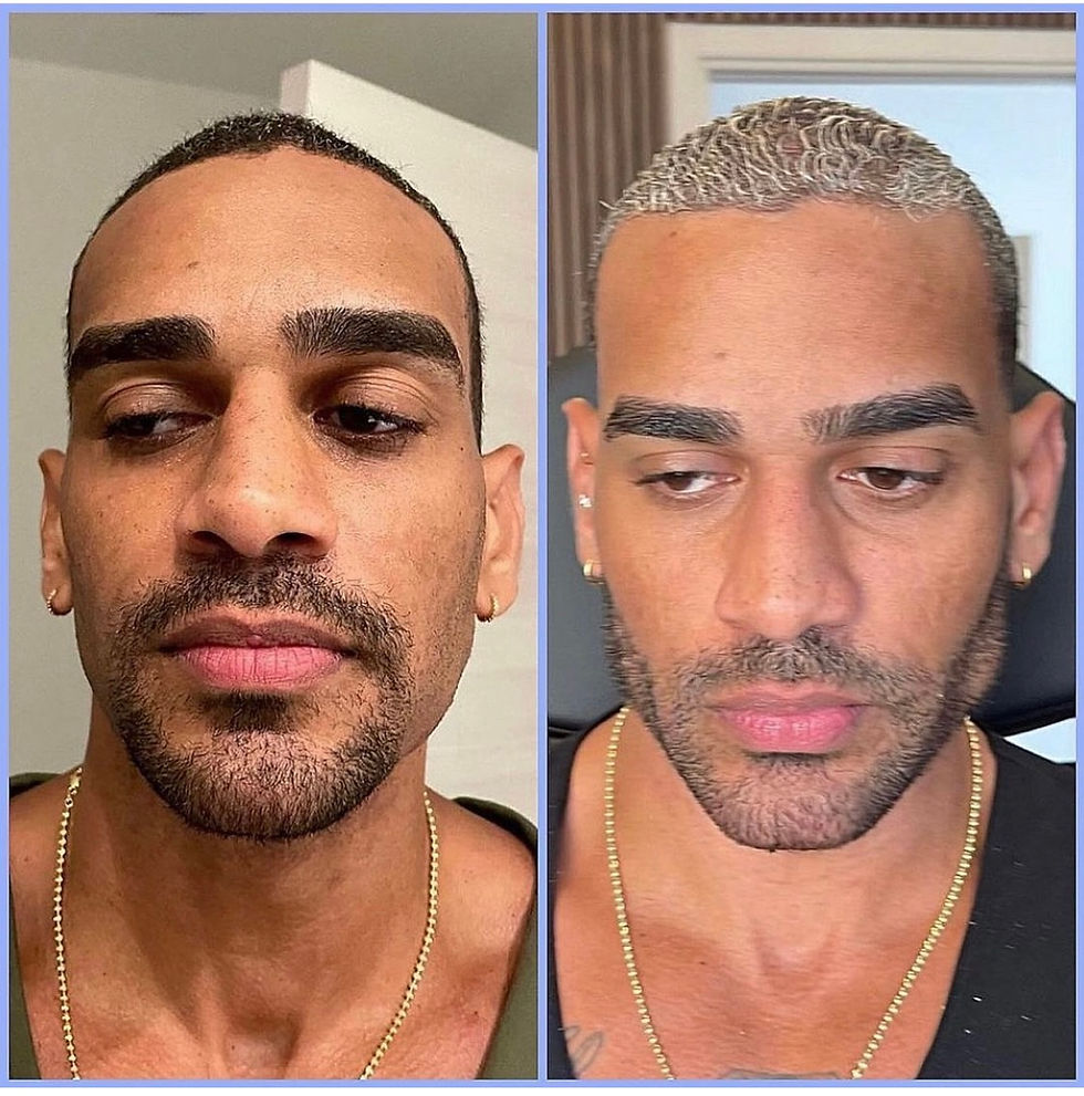 best filler miami jawline and chin filler