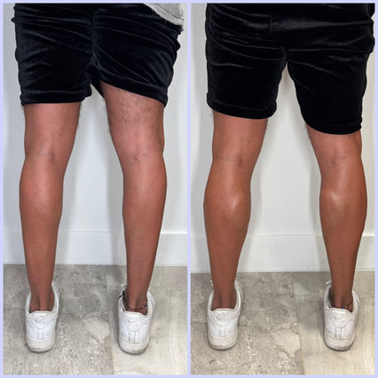 Calf filler before and after 