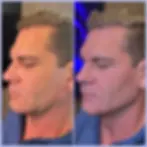Best filler miami. Jawline filler before and after