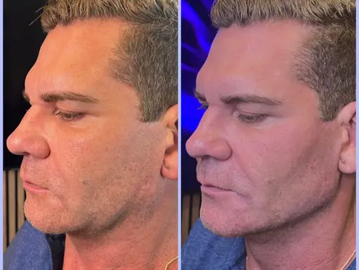 Miami Jawline Filler: Your Secret to a Stronger, Sexier Profile