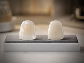 Por que escolher lentes de porcelana em vez de lentes de resina?
