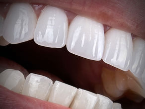 Resina e porcelana: materiais diferentes, resultados diferentes