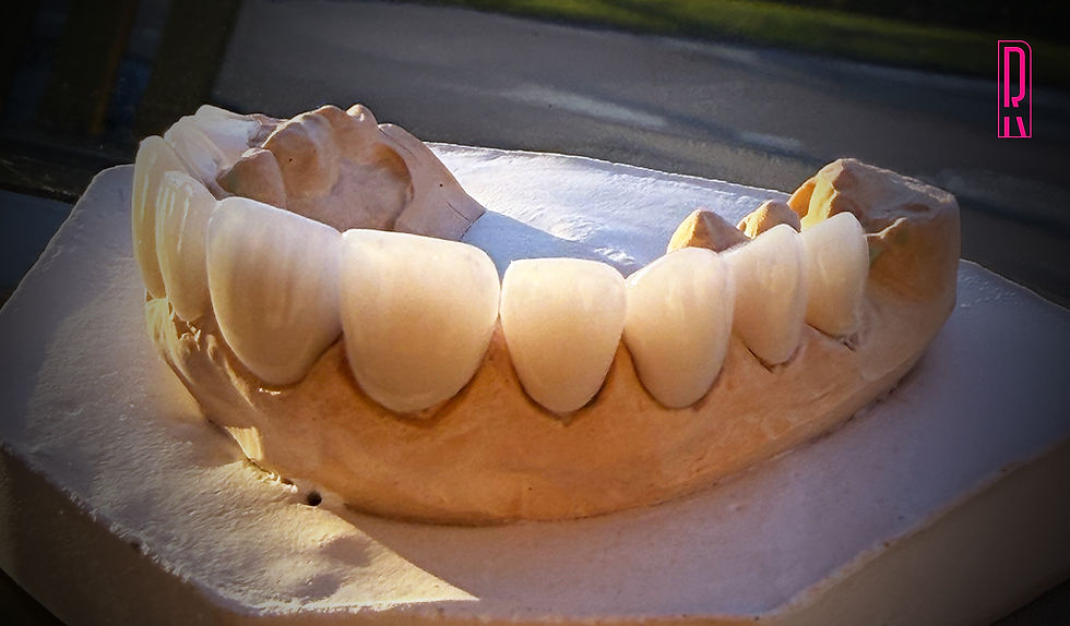 Exemplo de Lente de Porcelana Estratiticada Artesanal, na Rody Clinic.