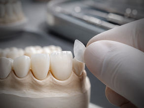 Nem todo preparo para lentes de porcelana desgasta o dente