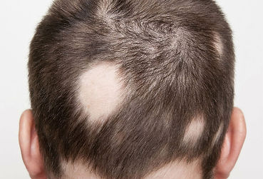 queda de cabelo: alopecia areata