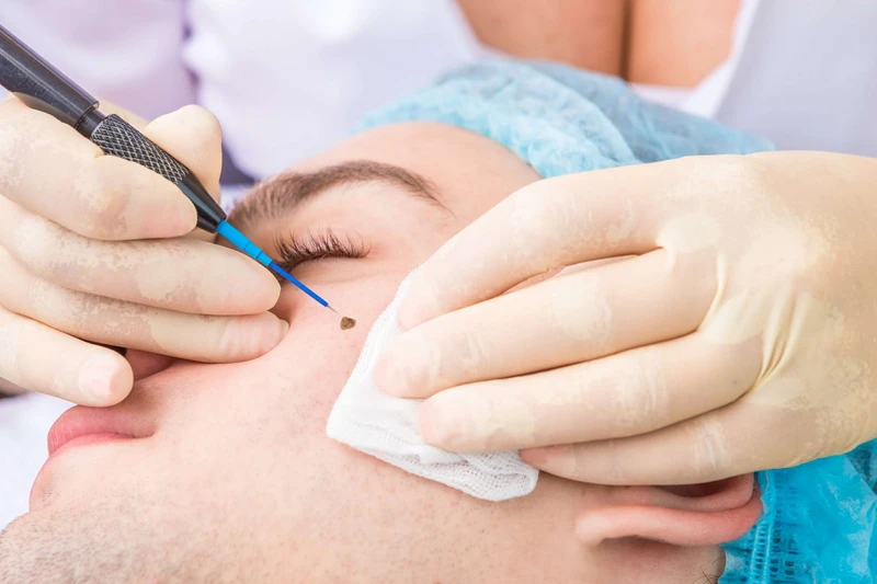 Blemish Removal 