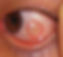 Conjunctival Swelling