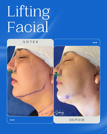 Dr. Ralph Sabag, Cirurgia Ortognática, Próteses Faciais Definitivas, Cirurgia Ortognática, Lifiting Facial.