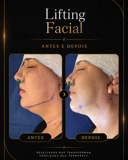 lifting facial