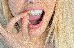 invisalign4.gif