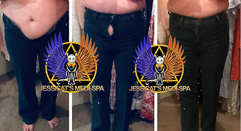 Before and After Body Treatments Results Jessicat's Medi Spa