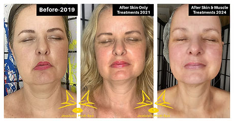 SUSAN O'CONNOR - BEFORE AND AFTER SKIN & MUSCLE TREATMENT (FRONT PROFILE)