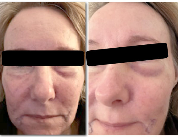 Martine After Full Face Fat Tranfer copy.jpg