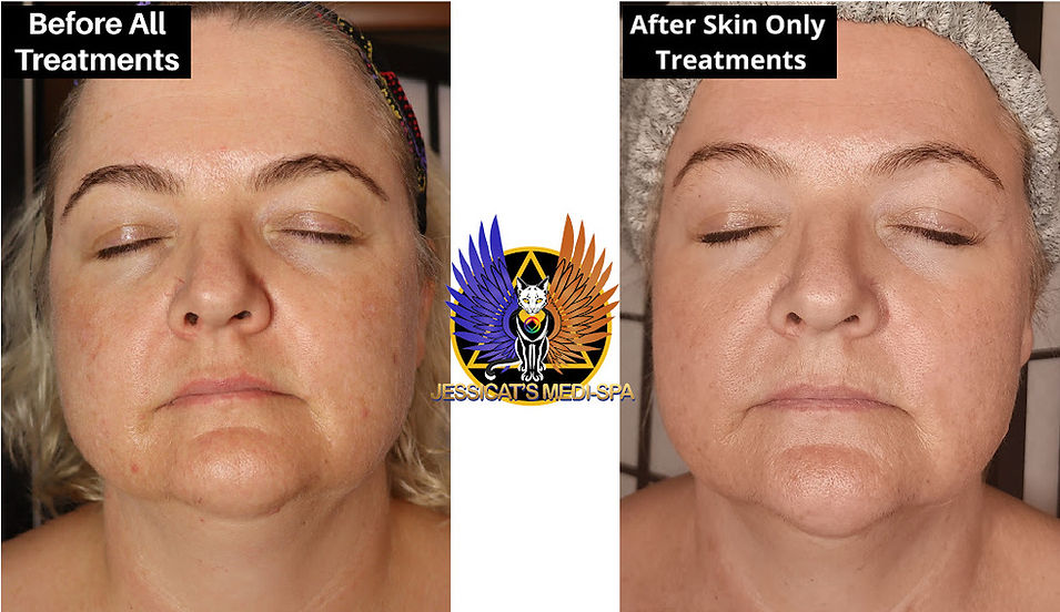 Before and After Skin Tightening Treatment