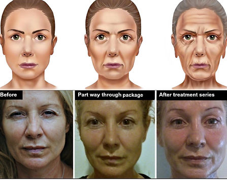 Radio Frequency Treatments Before and After