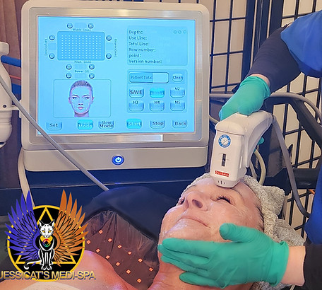 Jessicat's Medi Spa Provides HIFU Therapy Complimentary Within All Our Memberships