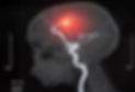 Stroke experts to test emerging nerve stimulation treatment I QUANTUNG PHARMA I www.quantung.com