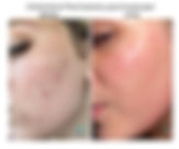 A chemical peel is a form of exfoliation that uses a chemical solution to remove dead skin cells from the top layer of skin. During the peeling process, the dead skin cells shed or flake off,  revealing fresh, new skin underneath.