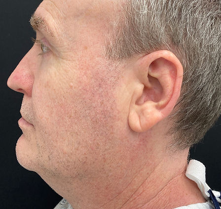 PH_FaceTite_Before_After_TM-LeftSide_Male (1).jpg