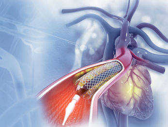 stent