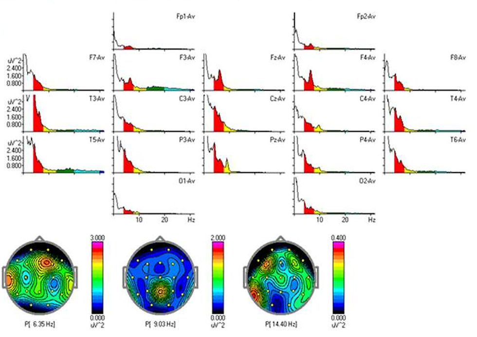 EEG 1