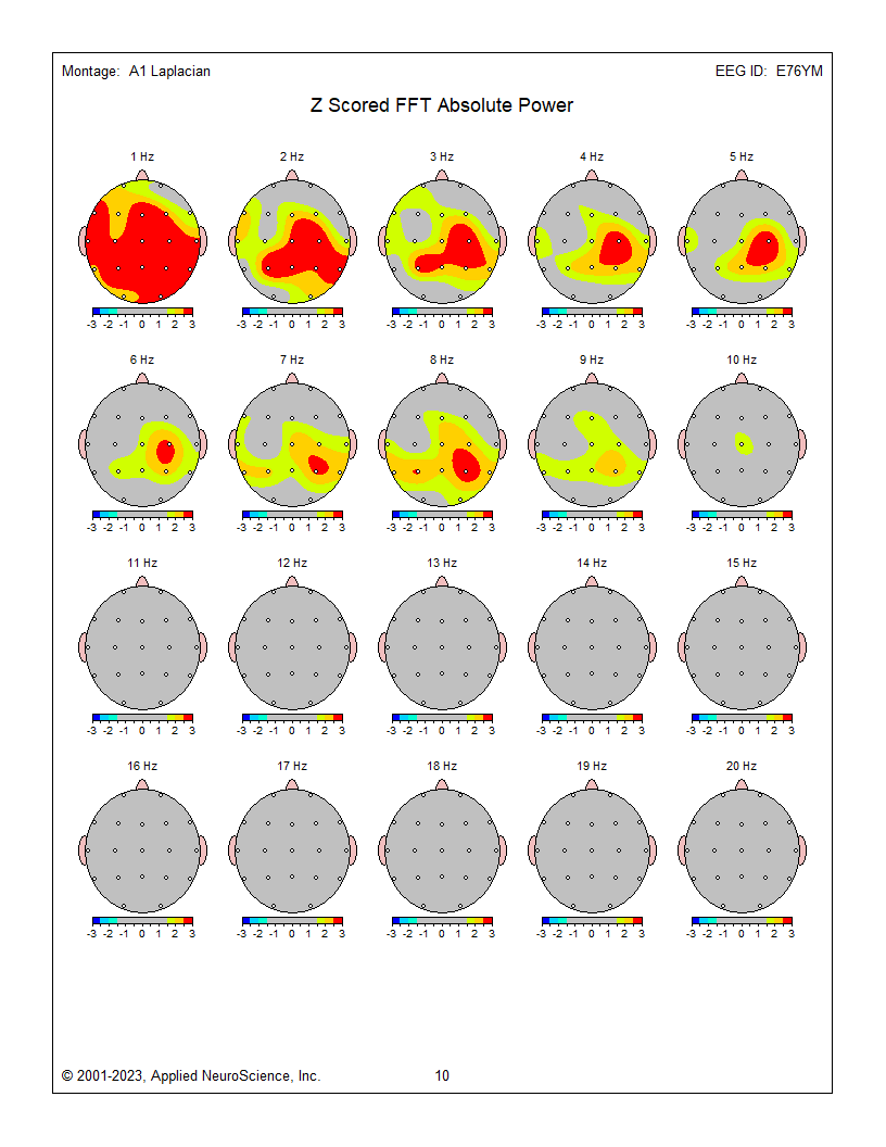 A Guide to Interpreting EEG Topographic Maps