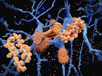 5-Min Science: Latest Findings on Alzheimer's Progression