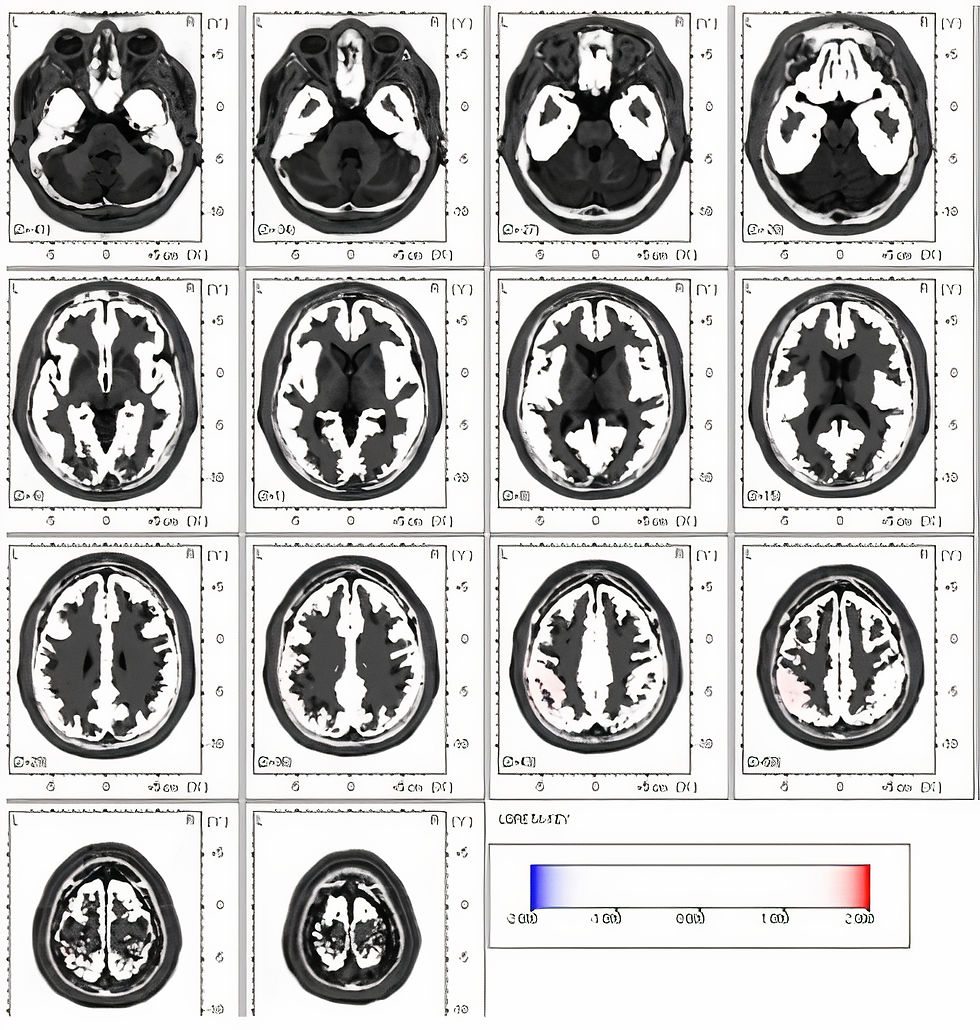 qEEG of TBI patient 2 months post-injury