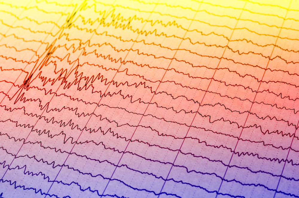 The Case for Using the Quantitative EEG (qEEG)