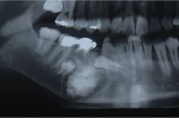 良性腫瘍 Clin Oral Oncol