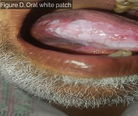 Oral white patch