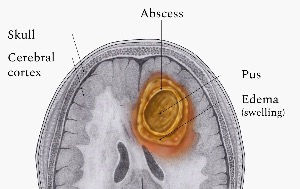 Brain abscess