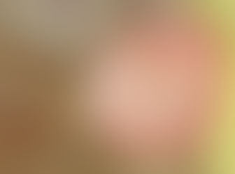 Surgery for Vestibular Schwannoma