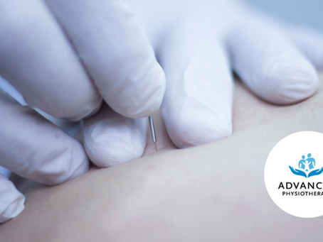 Dry Needling - More than just pins and needles.