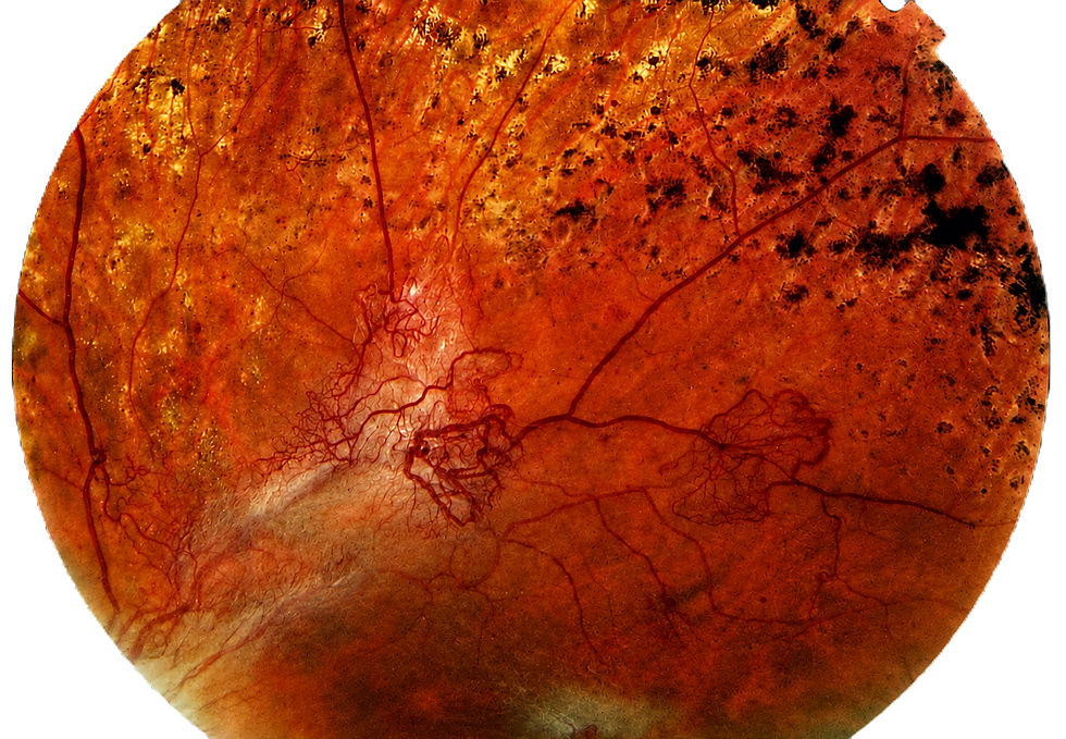 Retinal photograph showing proliferative